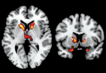 The Hidden Epidemic Exposed: The New Tardive Dyskinesia (TD) Resource Center