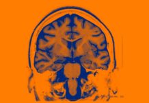 AI-Controlled Brain Implants for Mood Disorders Tested in People