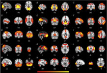 No Brain Connectivity Differences Between Autism, ADHD, and “Typical Development”