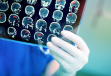 SSRI Antidepressants Do Not Improve Depression After a Stroke Doctor attentively examines the MRI scan of the patient.